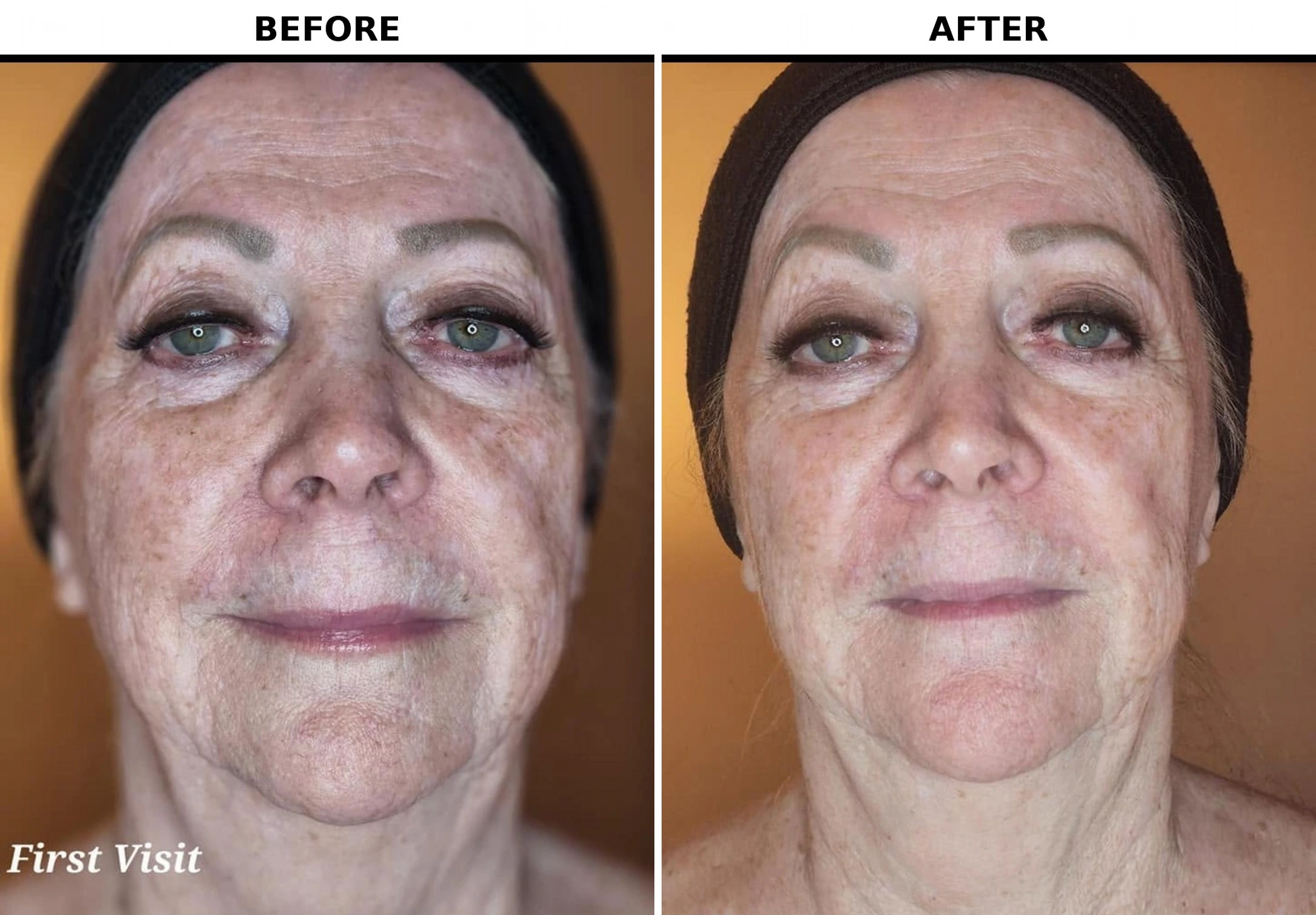 Bella facial vacuum therapy before and after photos from a first visit at Evolve EMS Therapy