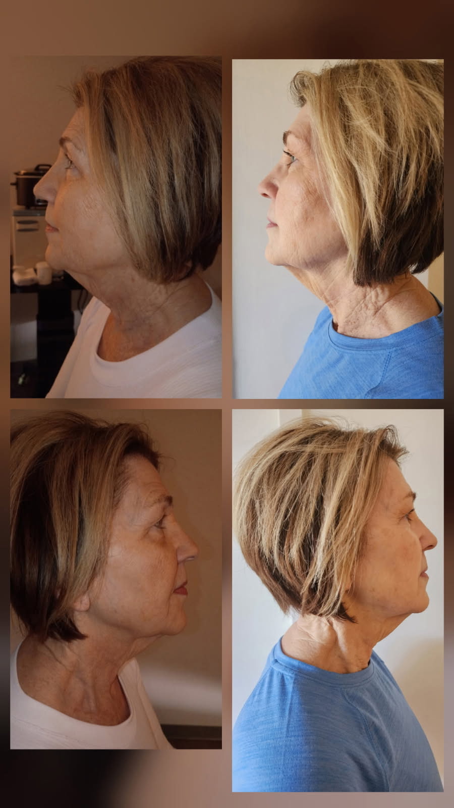PulseLift EMRF facial toning real client progress photos, side profile before and after sessions